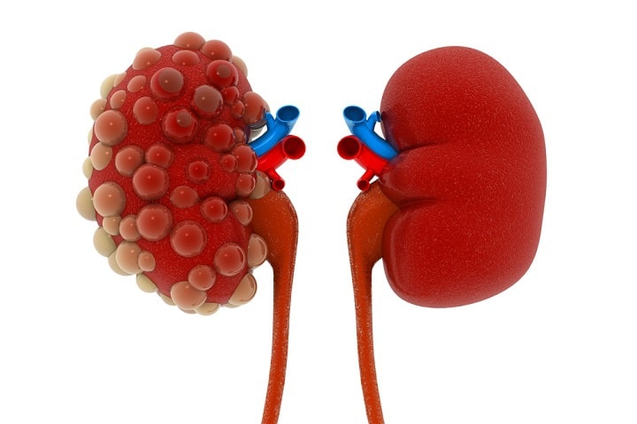 Illustration of a diseased kidney on the left and a healthy kidney on the right