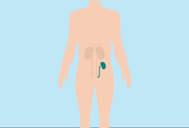 What is a kidney transplant