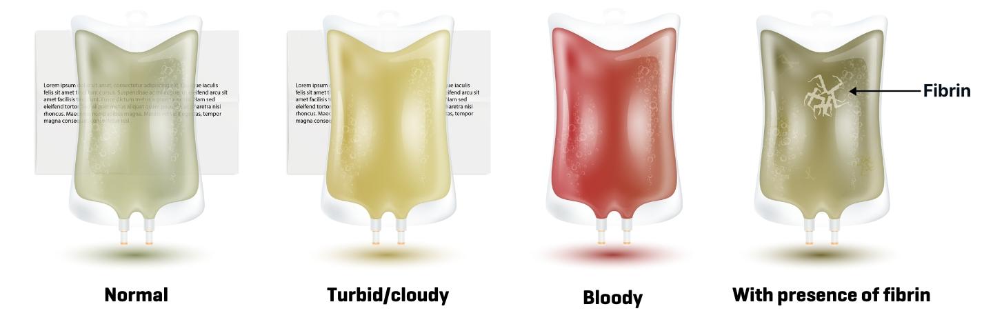Illustrations of dialysis effluent bags with different content