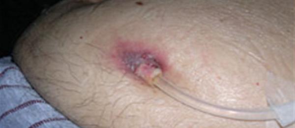 An infected exit with PD catheter inserted
