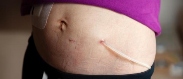 Clean exit site with catheter