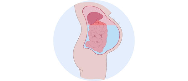 Symptoms of peritonitis - ascites